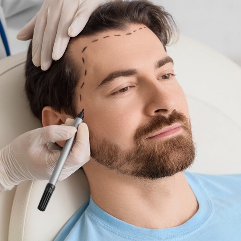 Surgeon marking a hairline before a hair transplant